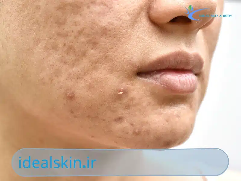 بوتاکس برای جای جوش