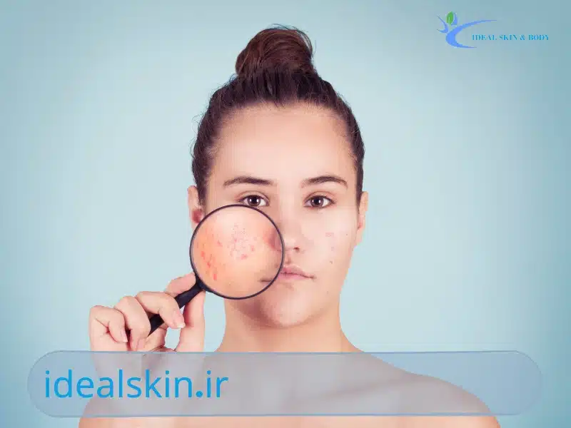 بوتاکس برای جای جوش