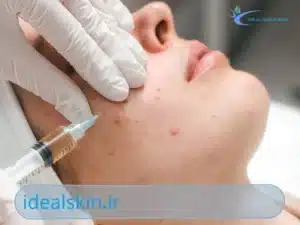 بوتاکس برای جای جوش