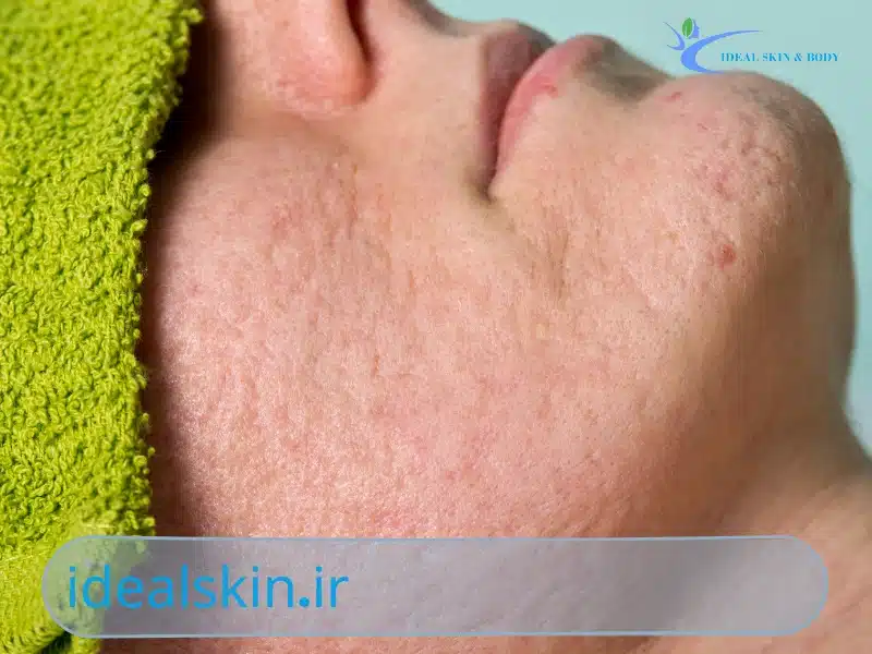 بوتاکس برای جای جوش