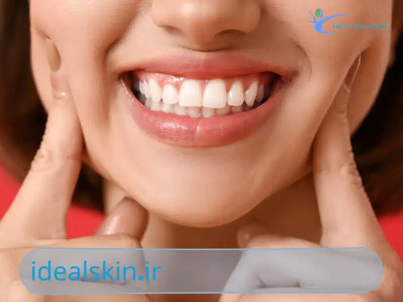 بوتاکس لبخند لثه ای
