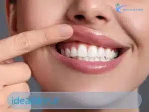 بوتاکس لبخند لثه ای