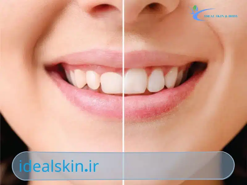 بوتاکس لبخند لثه ای