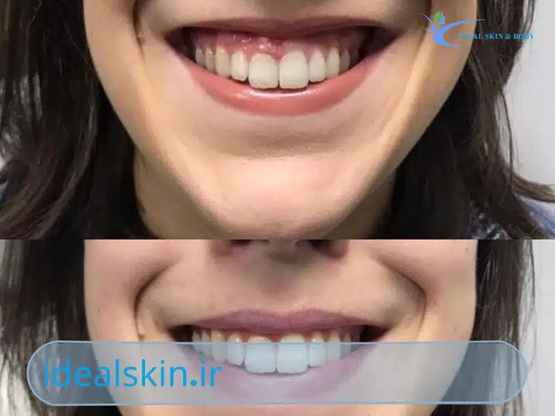 بوتاکس لبخند لثه ای