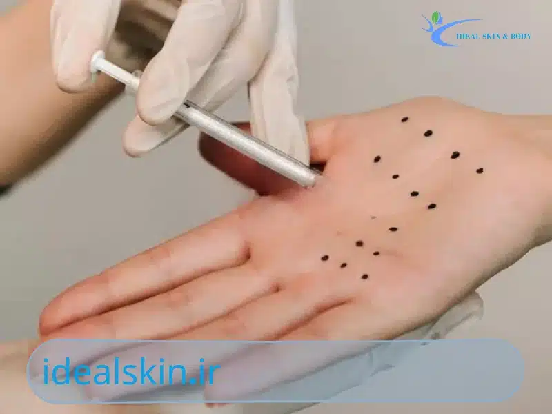 تزریق بوتاکس کف دست