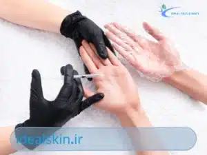 تزریق بوتاکس کف دست