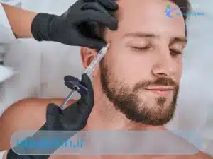 فیلر شقیقه