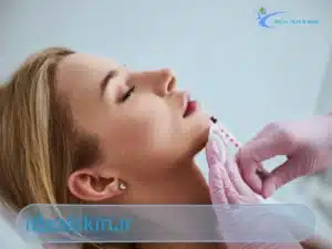 فیلر لب