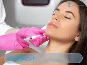 فیلر چانه