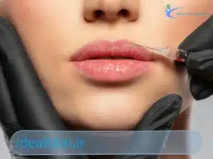 بوتاکس لب