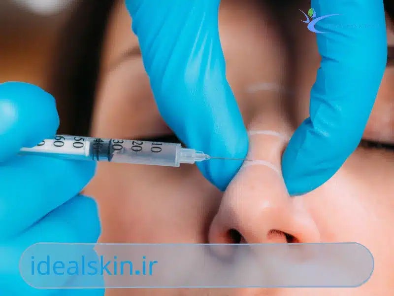 اثرات فیلر بینی و زمان مناسب برای عمل