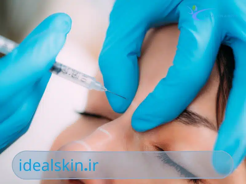 فیلر بینی برای بینی قوزدار