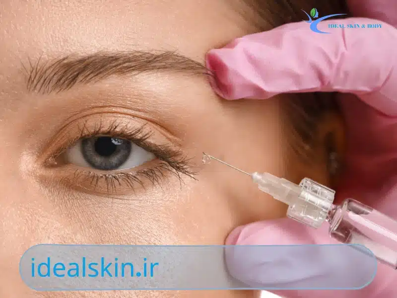 مزایای فیلر زیر چشم