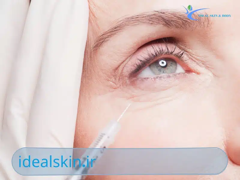 مزایای فیلر زیر چشم