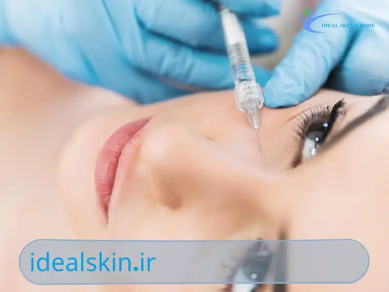مزایای فیلر زیر چشم