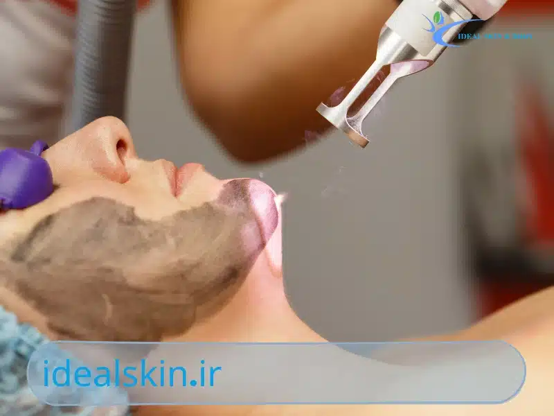 لیزر شاتی بهتره یا رولی