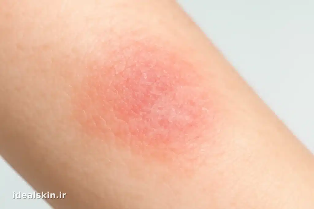 نمای کلوزآپ پوست با اگزمای خفیف در محیط کلینیک