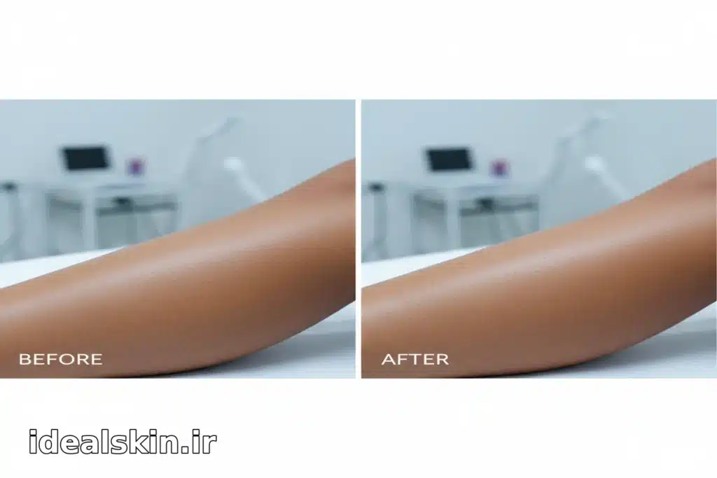 قبل و بعد از لیزر