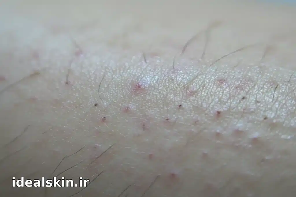 نمای ماکرو از سطح پوست پس از لیزر 