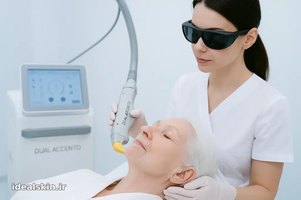 نمای نزدیک از هند‌پیس Dual Accento در ناحیه لب بالا برای حذف موی سفید