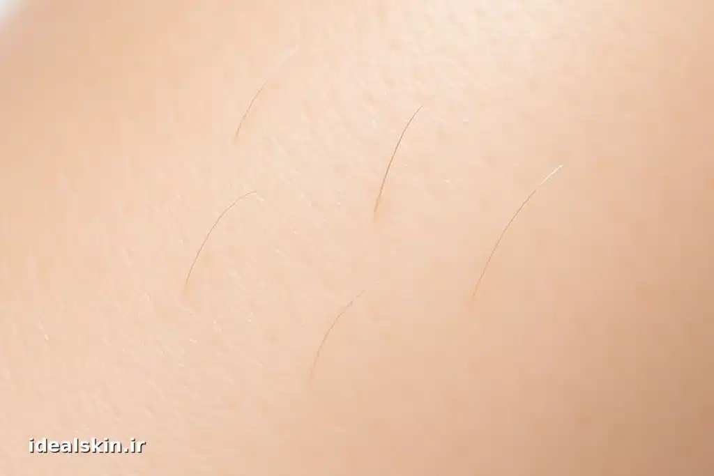 رشد بسیار ضعیف مو بعد از لیزر