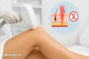 نمای نزدیک لیزر موهای زائد روی پوست و توقف سطحی پرتو