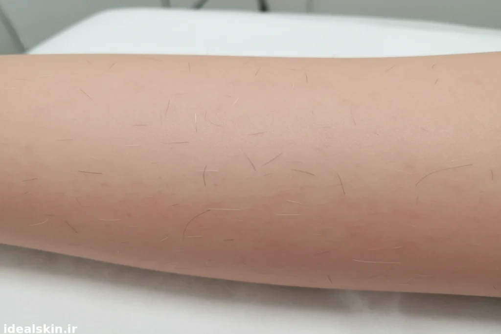 پوست صاف پس از لیزر روی موهای تیره و باقی ماندن تارهای موی سفید بدون آسیب