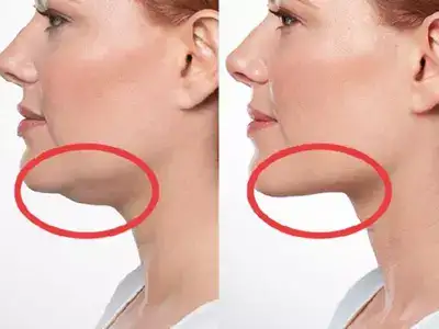 روش‌های تخصصی لیفت غبغب بدون جراحی