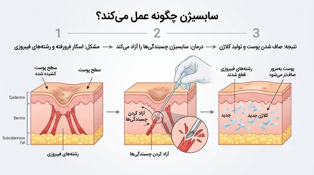 سابسیژن چگونه عمل میکند؟