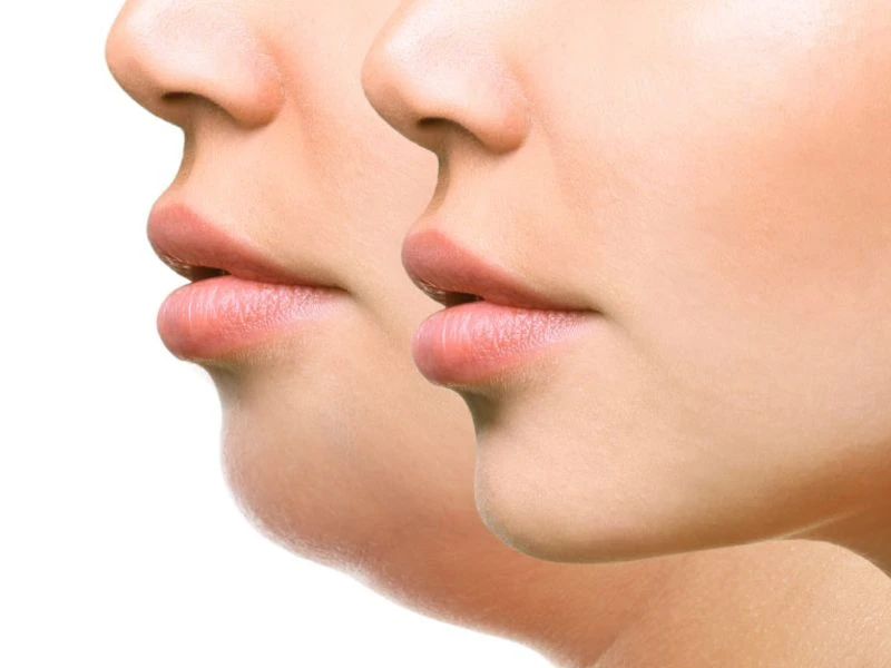 لیفت غبغب بدون جراحی در کلینیک ایده‌آل